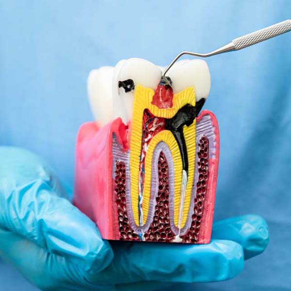 Root-Canal-Treatment