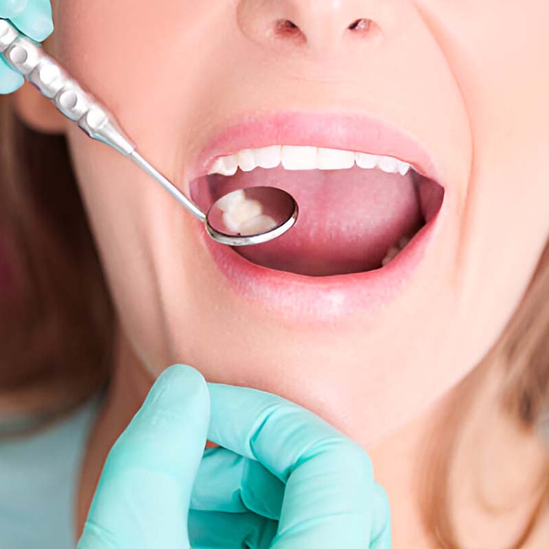 Why Choose Cloverpark Dental for Fillings