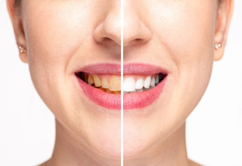 Common Signs You May Need a Teeth Whitening