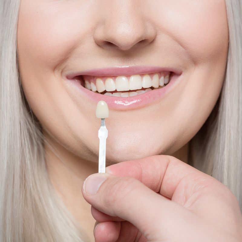 Why Choose Cloverpark Dental for dental veneer