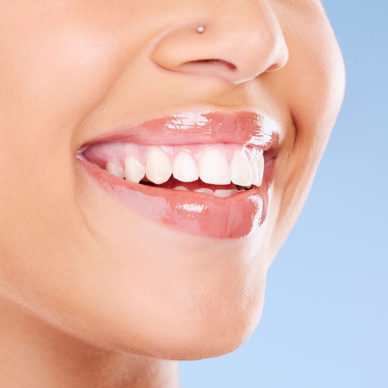 Why Choose Cloverpark Dental for teeth whitening